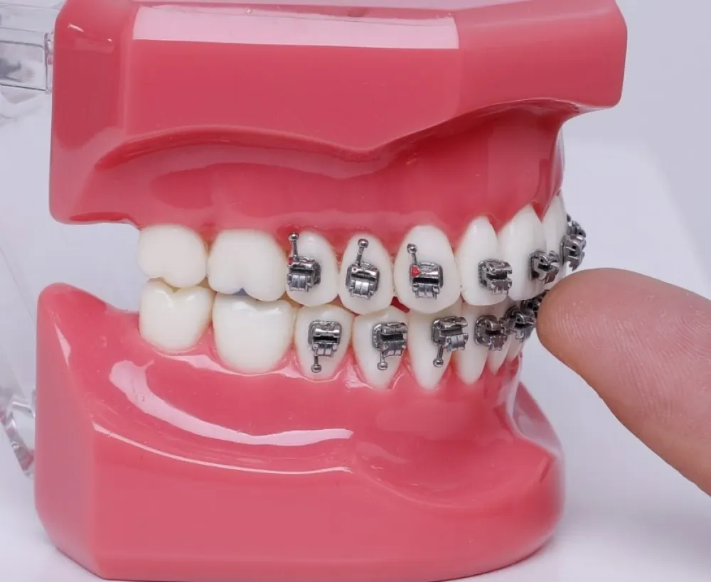 Brilliant 3rd Self-Ligating Brackets