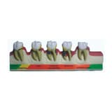 MediPros® Periodontal Disease Stages Model
