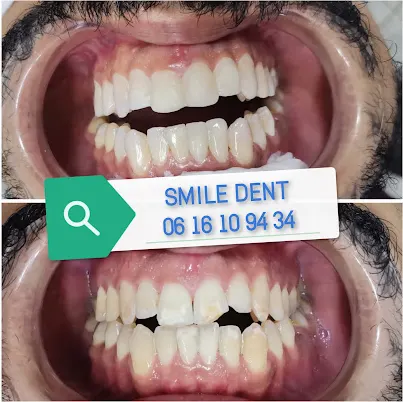 Smile dent