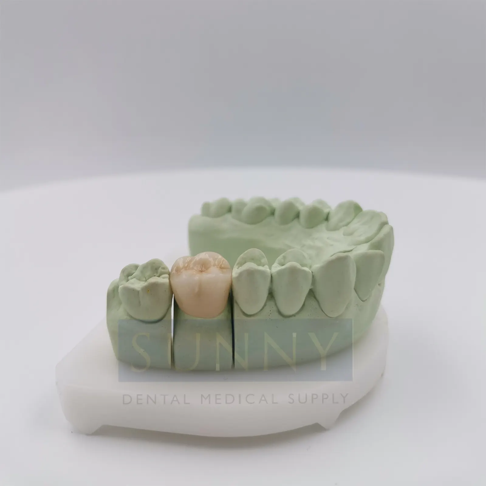 PFM (Porcelain-Fused-To-Metal)