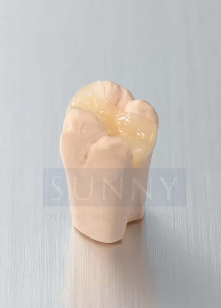 Inlays / Onlays