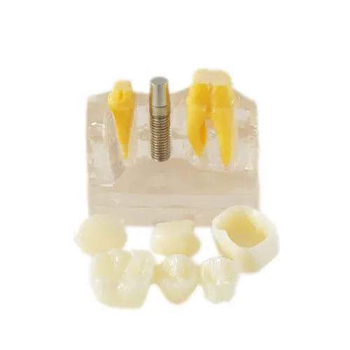HST IMPLANT MODEL – Clear