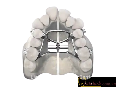 Ốc nong hàm cố định Palatal Expander RPE