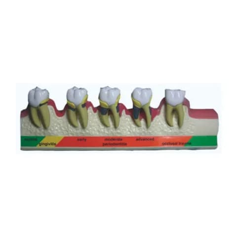 MediPros® Periodontal Disease Stages Model