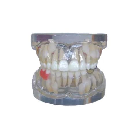 MediPros® Premature Loss of Deciduous Teeth Study Model