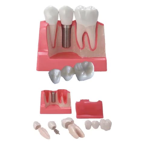 MediPros® Implant & Bridge Model