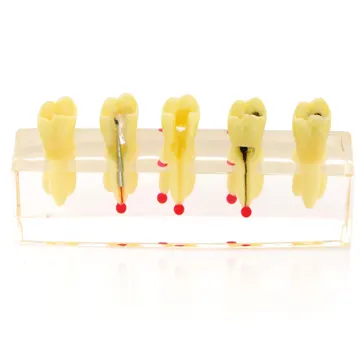Modèle de traitements des maladies pulpaires