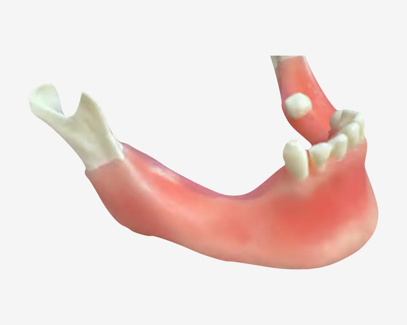 BONE AUGMENTATION – REGENERATION – BA 10