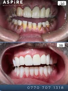 عيادة اسباير لتجميل وزراعة الاسنان