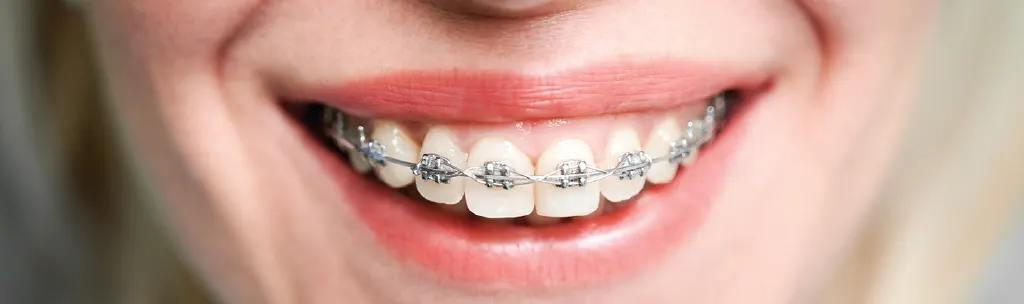 Brackette Orthodentic