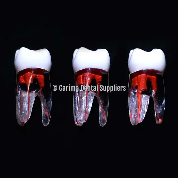 JM Open Pulped Root Canal