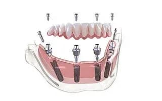 Bego MultiPlus Restoration